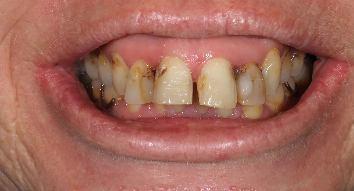 Before