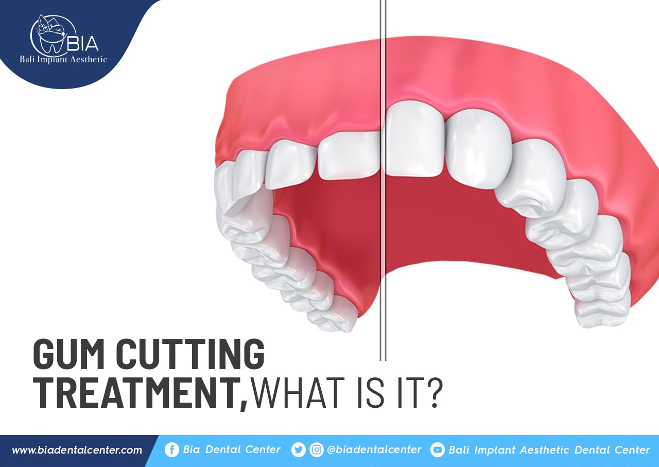 Blog Article Bia Dental