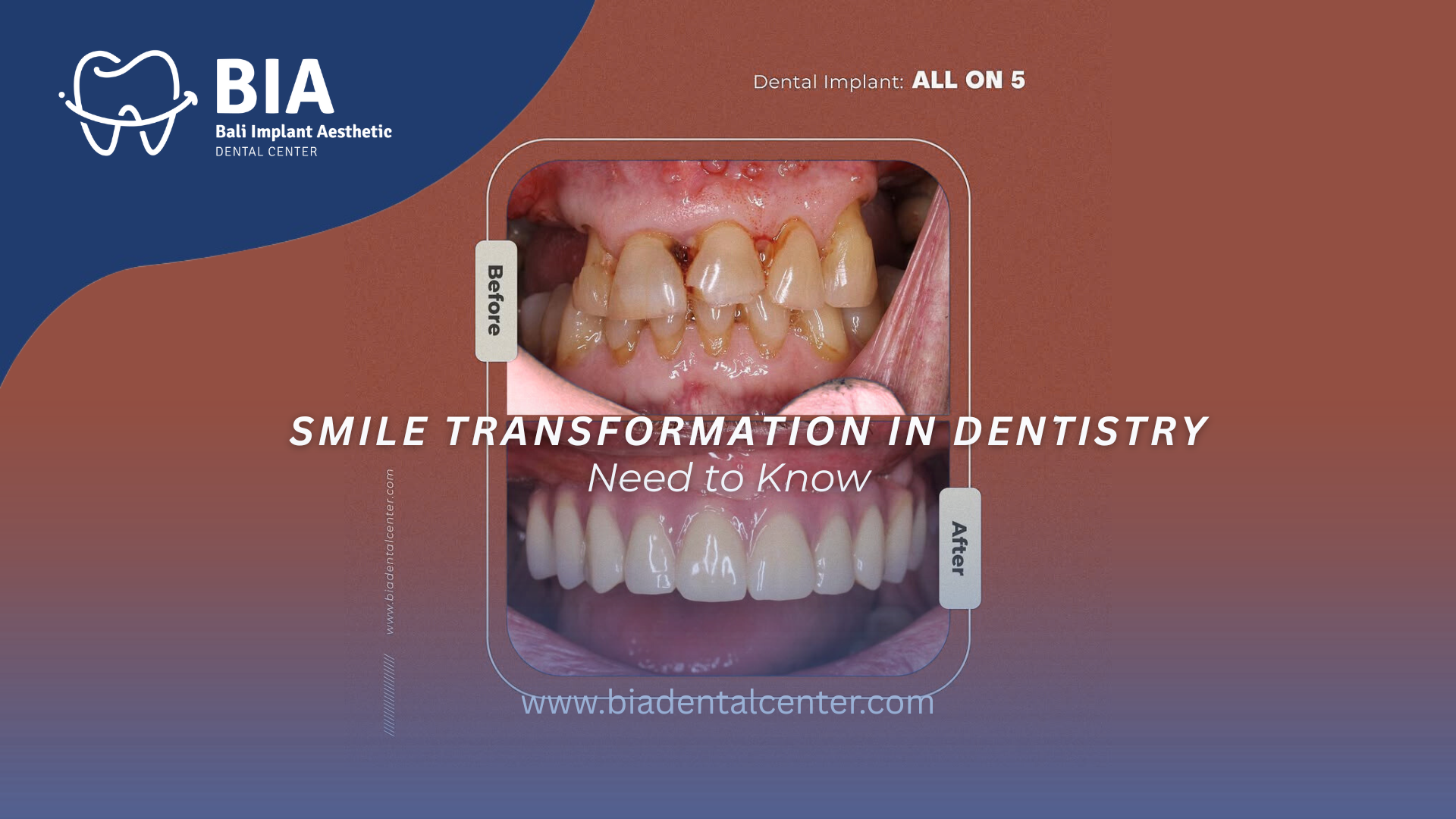 Blog Article Bia Dental