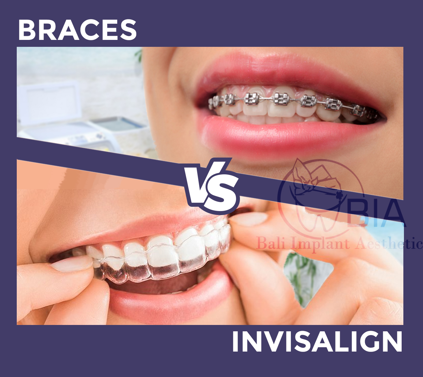 Blog Article Bia Dental