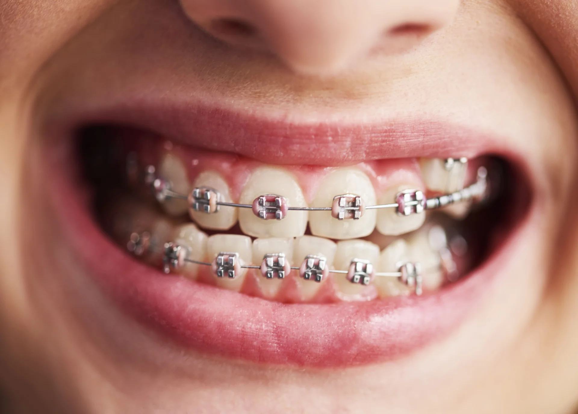 Different Types of Braces