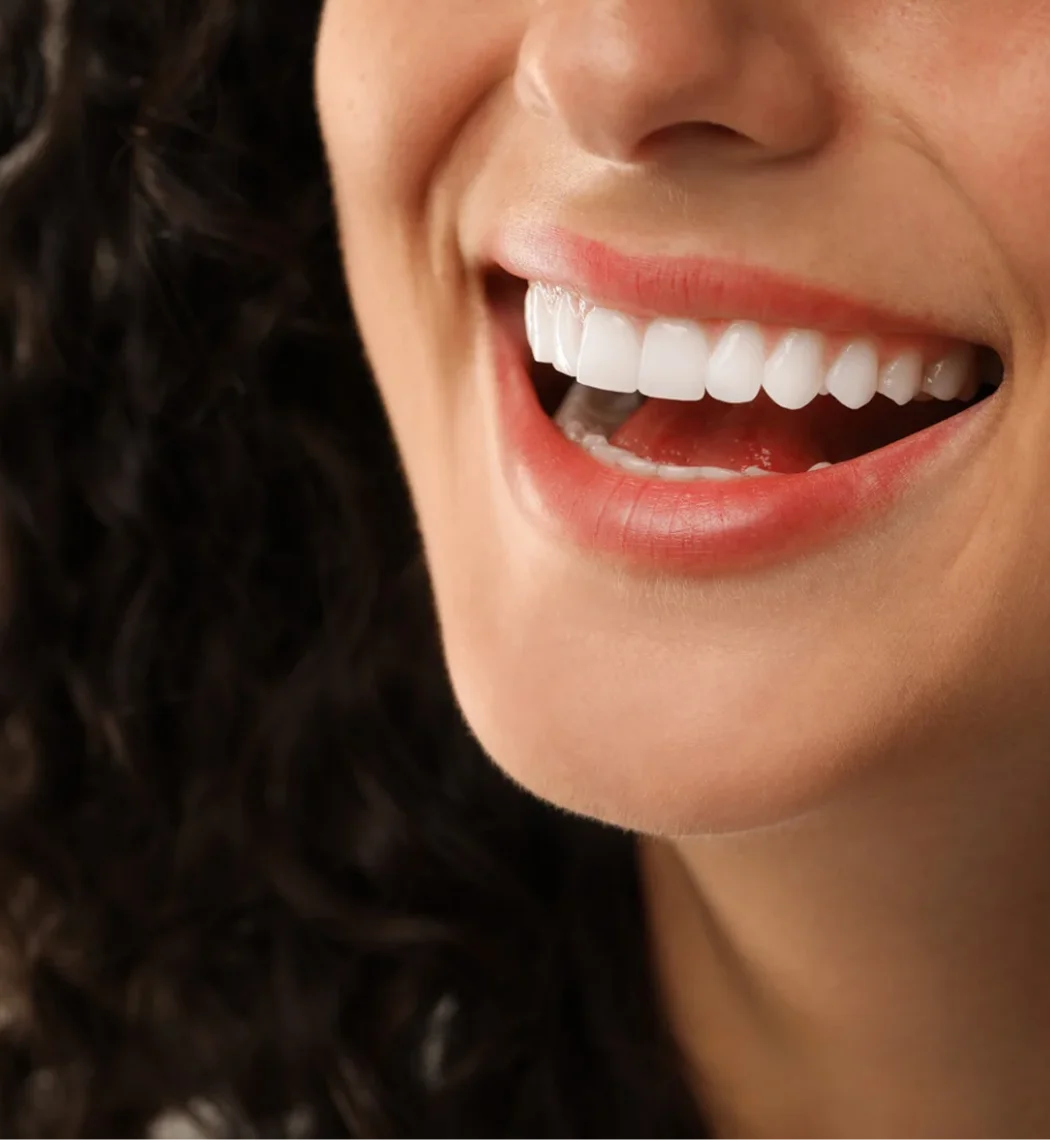 Veneer Bia Dental